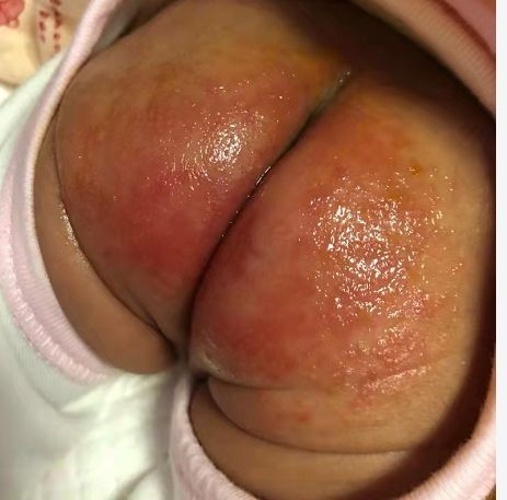 寶寶紅屁屁照片 (45) 