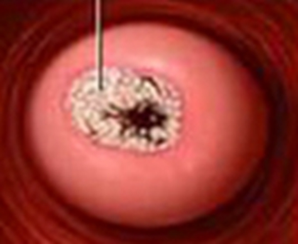 外陰潰瘍細菌病毒