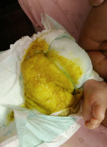 新生兒消化不良大便圖 (67) 