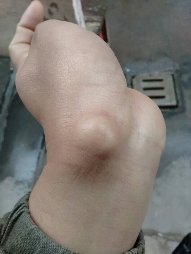 左手腕手腕腱鞘炎