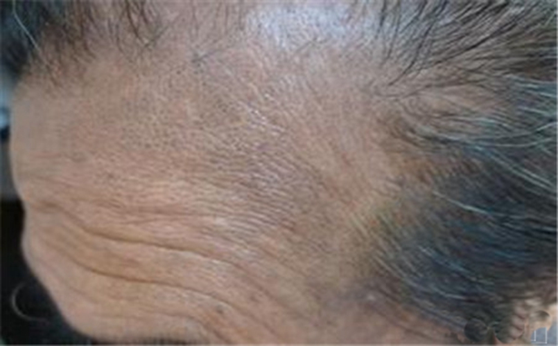 額頭患有皮膚黑變病