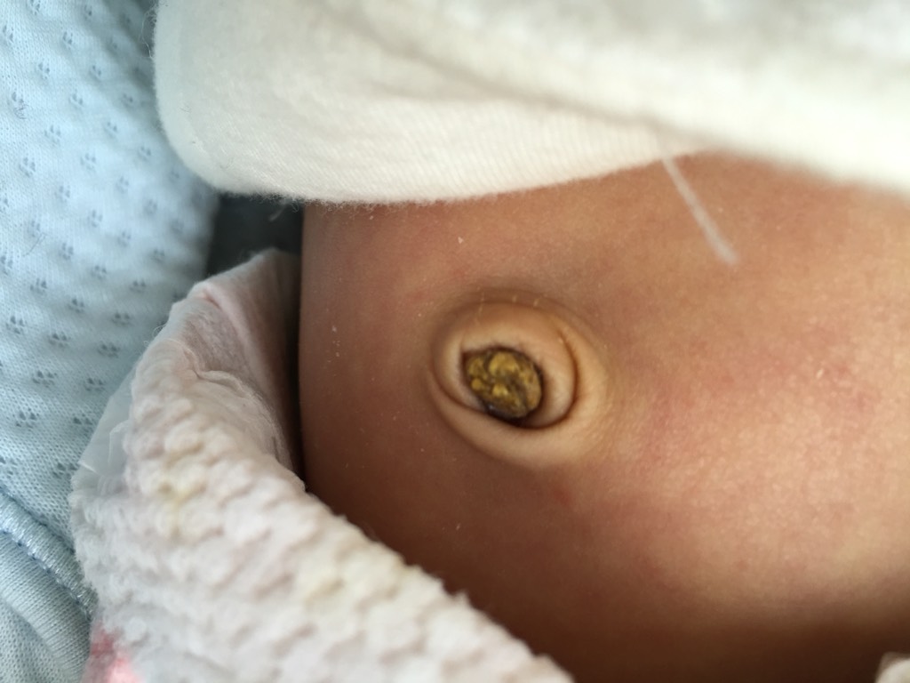 新生兒肚臍脫落圖 (41) 