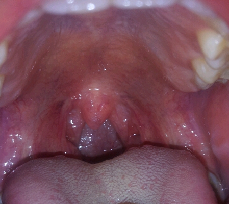 食道炎症狀 (42) 