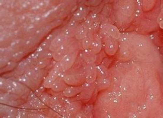 性病性淋巴肉芽腫套圖 (46) 