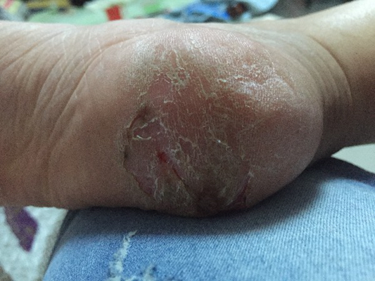 腳底乾裂 (8) 
