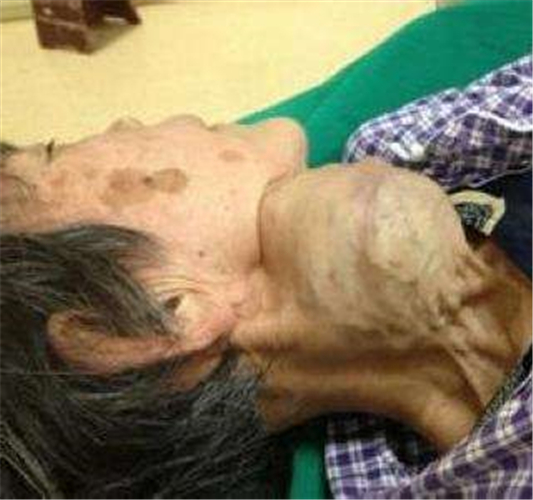 老人甲狀腺結節