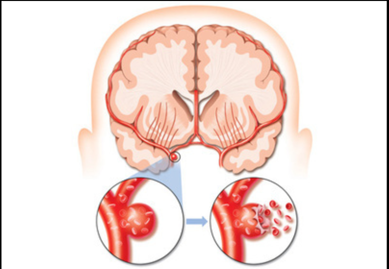 腦血管痙攣的病理圖 