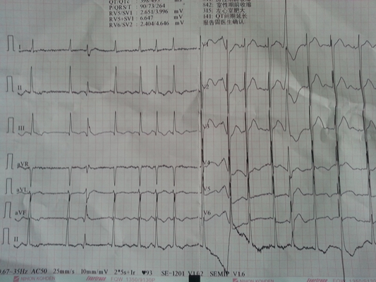 預激綜合徵心電圖 (9) 