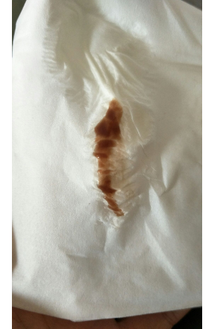 白帶帶有褐色分泌物 (50) 