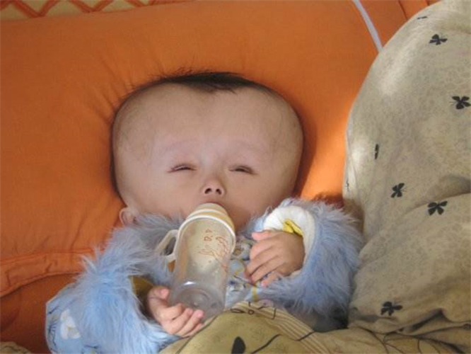 重度腦積水寶寶