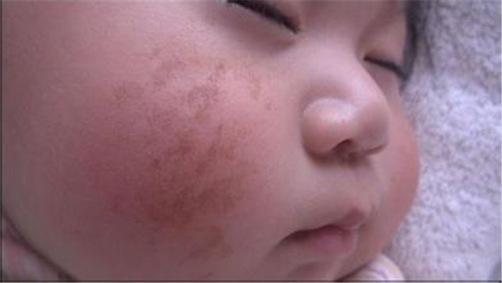 牛奶咖啡斑 (41) 