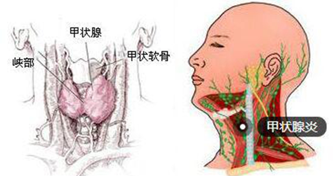 橋本甲狀腺炎有結節