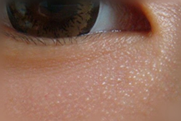 粟丘疹 (3) 