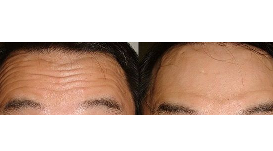 磨皮手術效果圖 (38) 