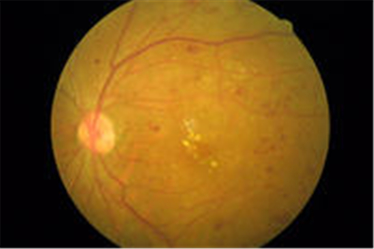 小範圍視網膜脫落