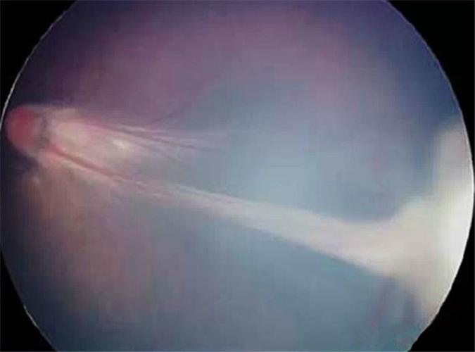 早產兒牽拉性視網膜脫落