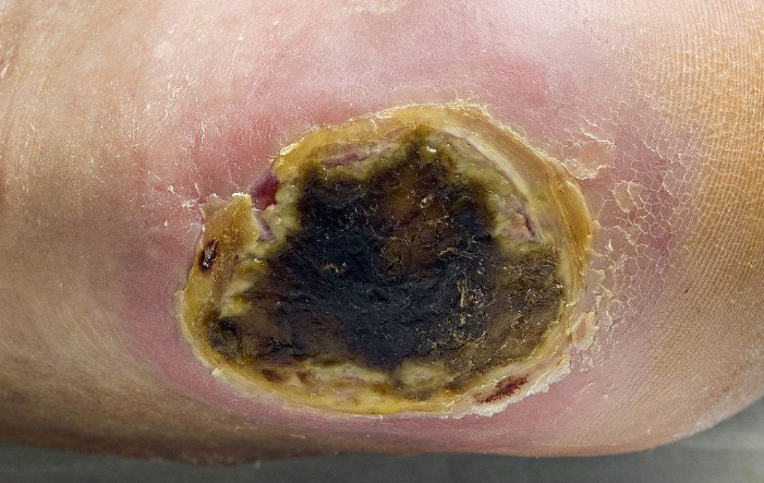 脈管炎早期症狀