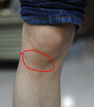 脛骨結節骨骺炎 (6) 