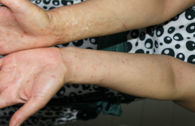 身體蟎蟲過敏症狀