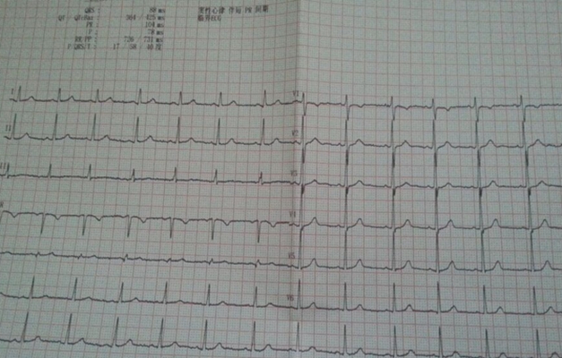 預激綜合徵心電圖 (84) 