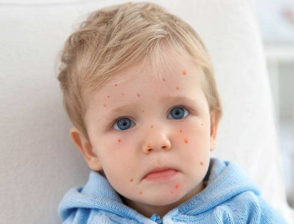 長水痘的症狀 (61) 