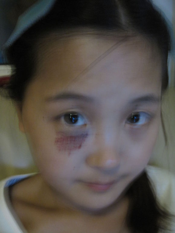 眼睛周圍太田痣