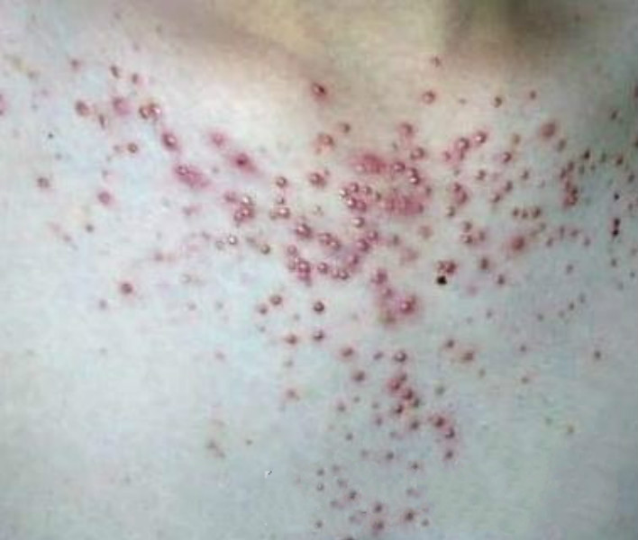 胸部皮膚念珠菌病擴散