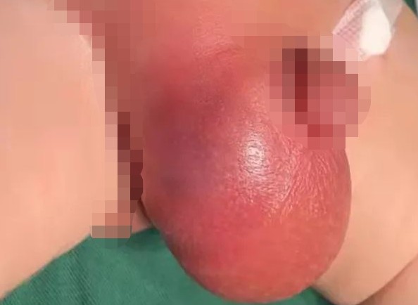 男寶寶疝氣的症狀