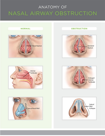 鼻中隔彎曲手術圖解 (30) 