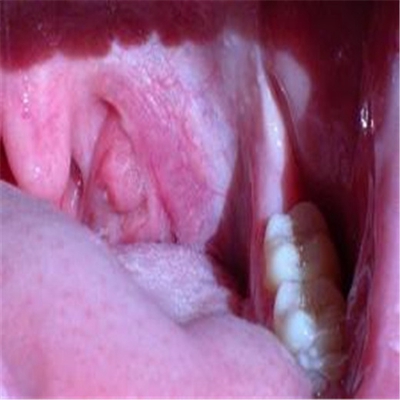 扁桃體癌圖  (53) 