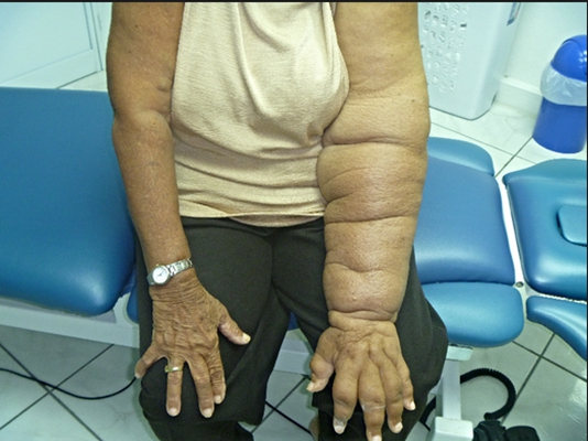 肢端肥大症  (46) 