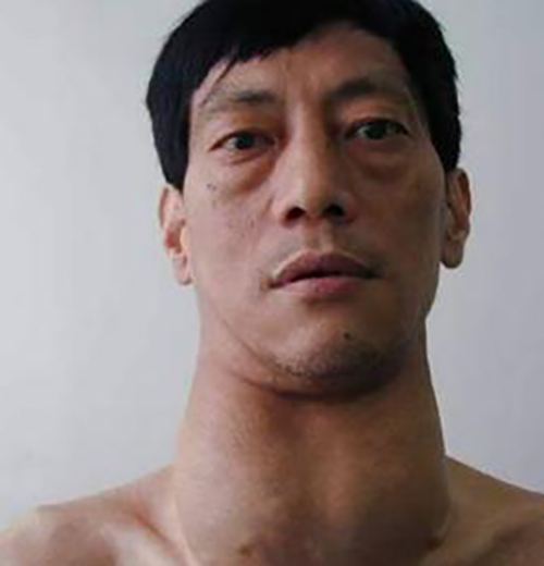 雙側甲狀腺腫大