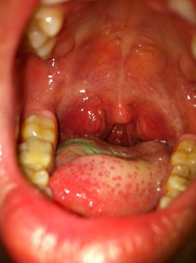 食道炎的症狀圖 (47) 