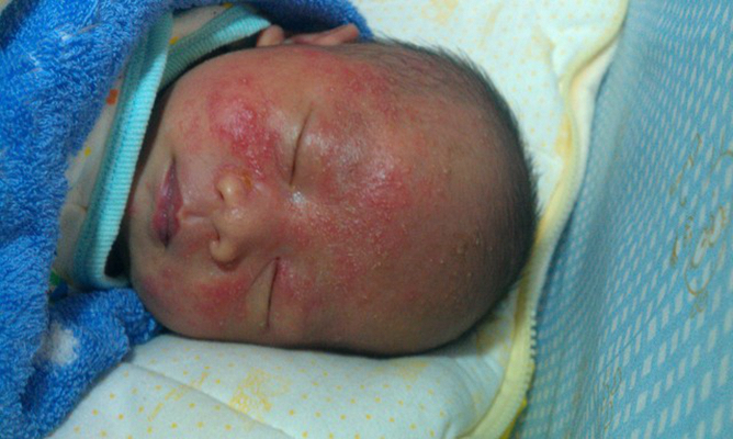 新生兒胎毒的症狀