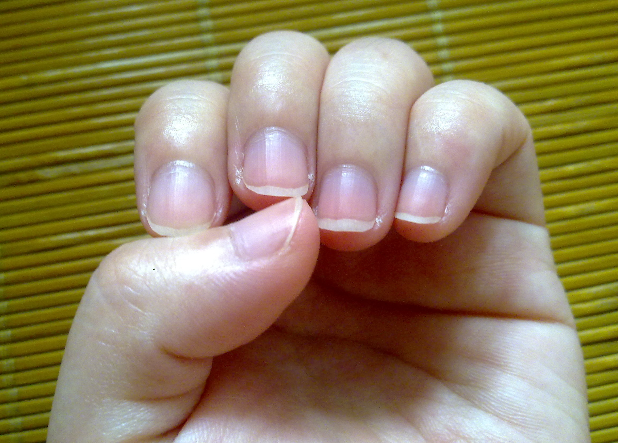 貧血指甲