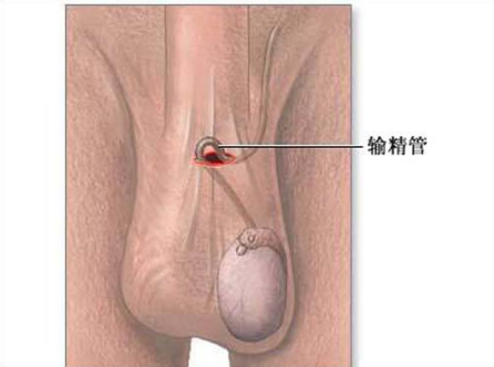 精索曲張睪丸下墜時