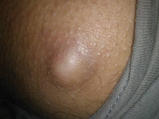 臀部癤子的症狀