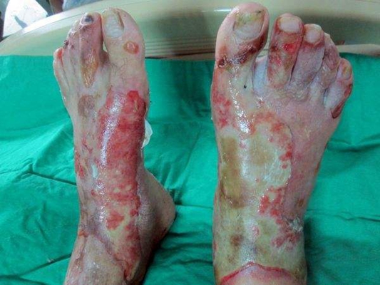 深二度燒傷 (51) 