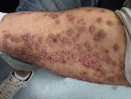 結節性癢疹 (44) 