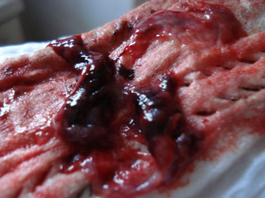 流產掉下來的孕囊