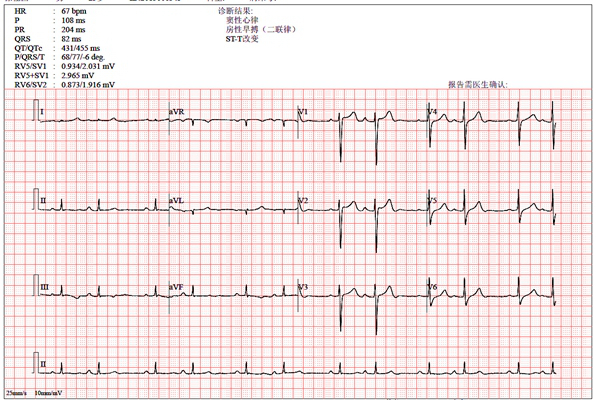 房顫心電圖特點 (70) 