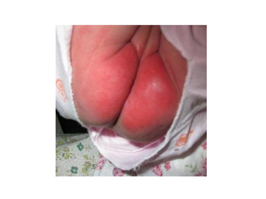 嬰兒肛周膿腫 (20) 