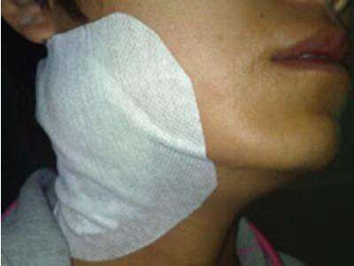 慢性淋巴結炎 (31) 