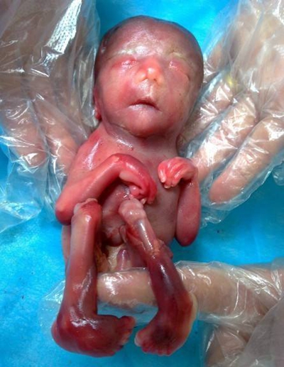 胎兒畸形 (44) 