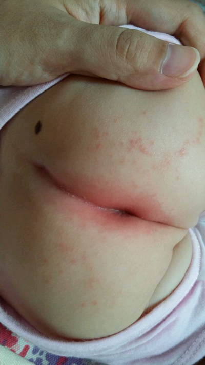 嬰兒肛周膿腫 (15) 