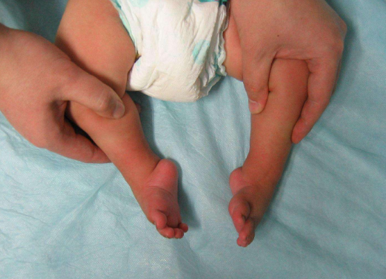 痙攣型腦癱 (53) 