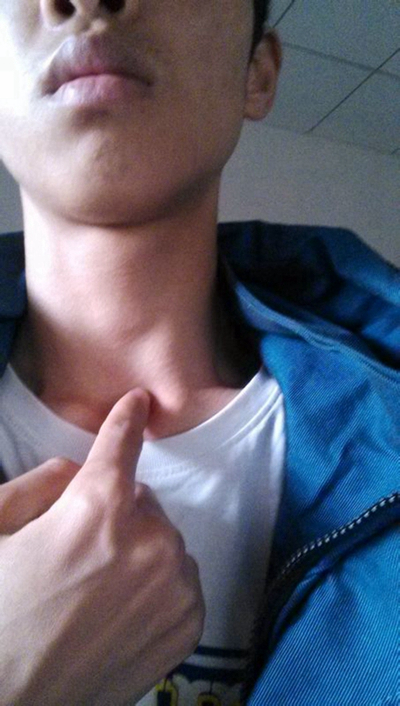 頜下淋巴結腫大