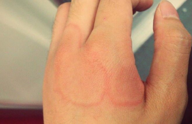 身體蟎蟲過敏症狀