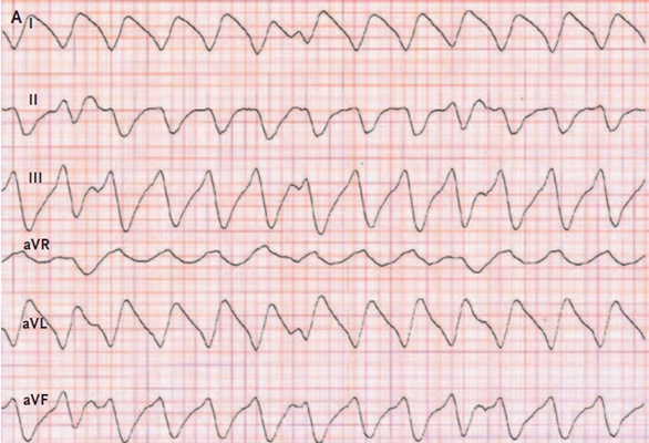高鉀血癥心電圖 (54) 