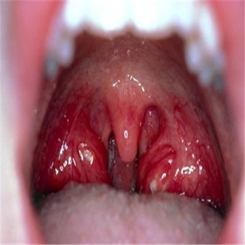 呼吸道感染兩側發炎